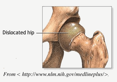 Hip Dysplasia